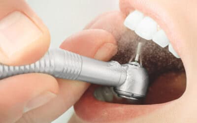 Így kezeli a lyukas fogat a fogorvos