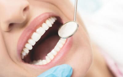 Miért fontos a fogkő leszedése?