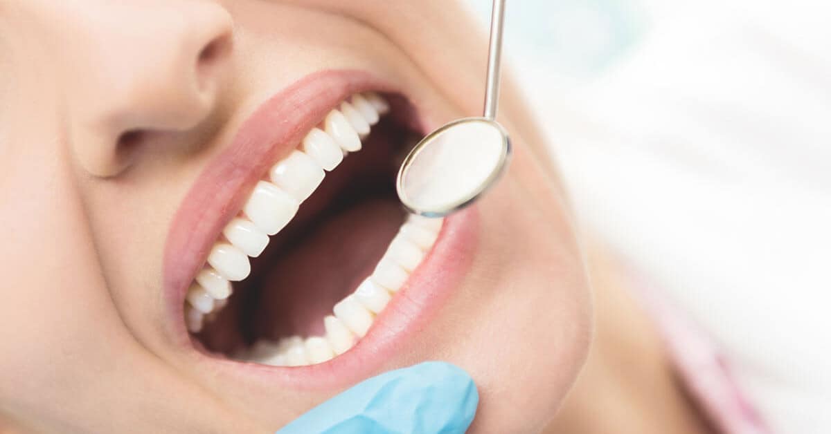 Miért fontos a fogkő leszedése?