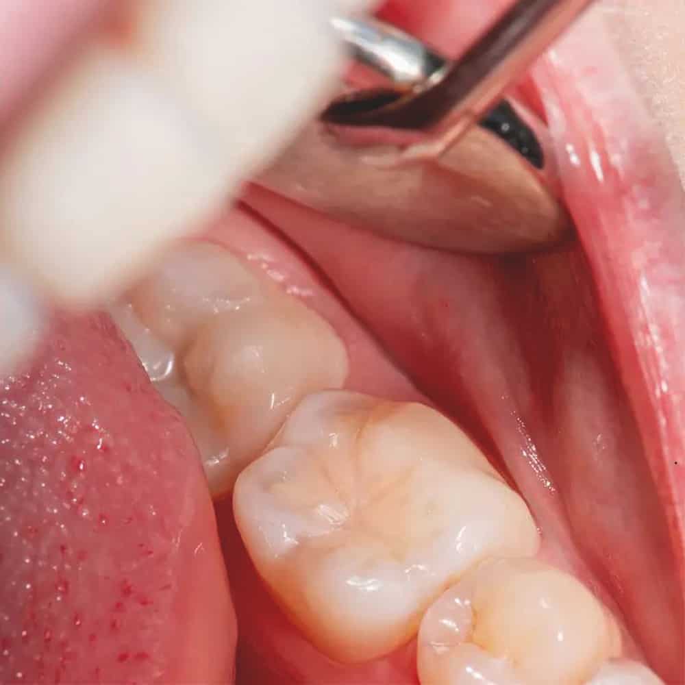 Konzerváló fogászat