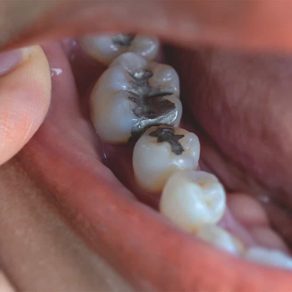 Konzerváló fogászat 5
