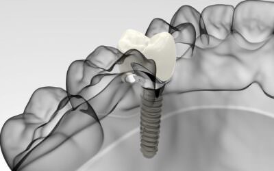 Az Alpha Bio fogimplantátumok előnyei