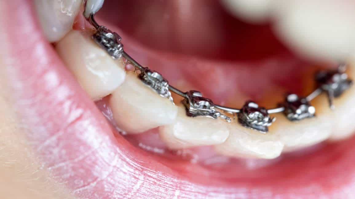 Belső fogszabályozó a fogorvosnál 2