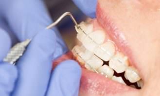 önligírozó fogszabályozó működése
