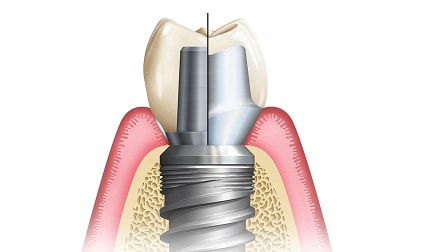 Kép egy korszerű fog implantátum ról