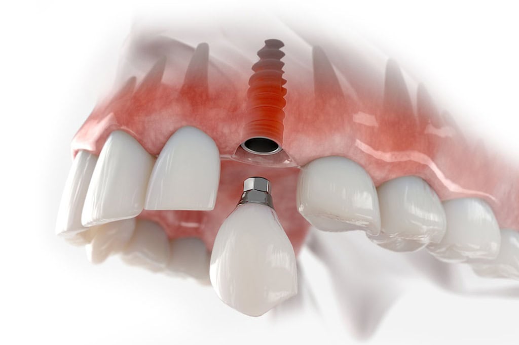 img-implan2t684