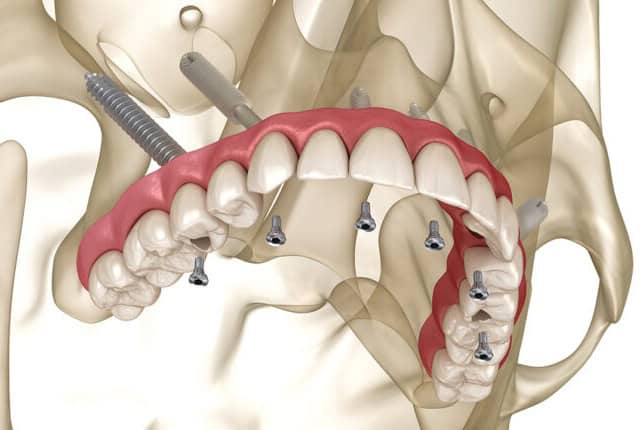 Maxillary prosthesis supported by zygomatic implants. Medically accurate 3D illustration of human teeth and dentures