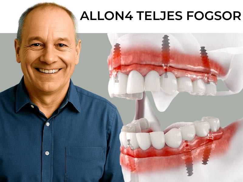 Teljes fogsor akció