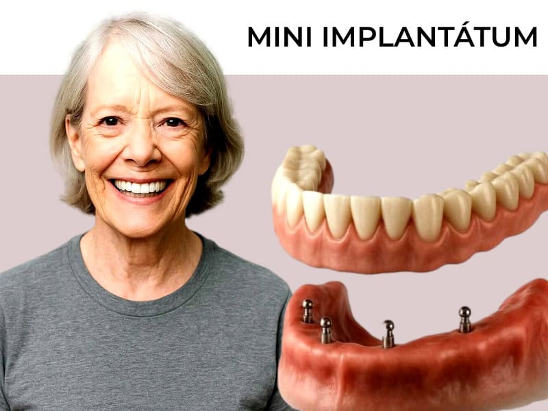 fogimplantátum akció