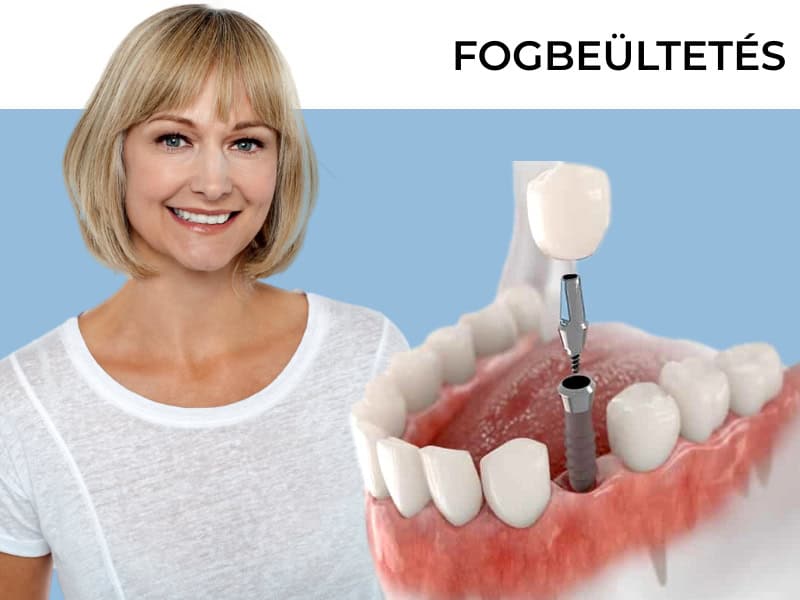 Fogbeültetés akció