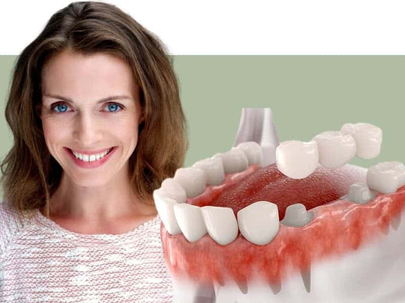 fogkorona és híd akció