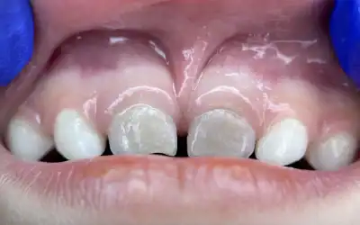 Fogak elszíneződése gyermekeknél: okok, megelőzés és kezelési lehetőségek