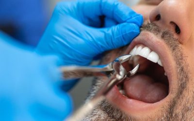 Foghúzás – Amit érdemes tudni a beavatkozás előtt és után