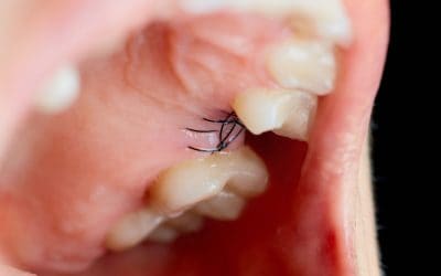 Foghúzás után – mire figyeljünk, hogy gyorsabb legyen a gyógyulás?