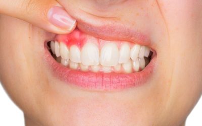 Fogínygyulladás kezelése házilag – Amit érdemes tudnod