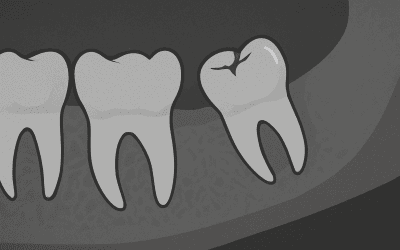 Letört bölcsességfog – okok, tünetek, kezelés és eltávolítás lépésről lépésre