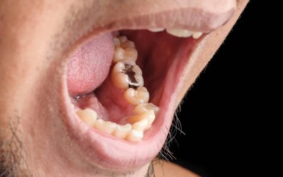 Amalgám tömés – veszélyei, hatása a szervezetre és az amalgám kivezetése