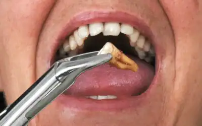 Bölcsességfog eltávolítása – mikor szükséges és hogyan zajlik?