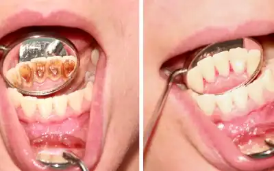 Fogkő: Mit érdemes tudni róla és hogyan távolítható el?