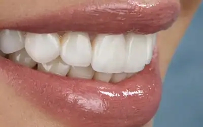 Porcelán héj ár – Mennyibe kerül a tartós és esztétikus mosoly?