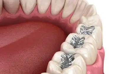 Amalgám tömés – káros hatások, csere, eltávolítás és gyakori problémák