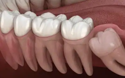 Bölcsességfog műtét: menete, ára, gyógyulás és minden, amit tudni érdemes