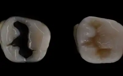 Amalgám tömés: minden, amit a hátrányokról, cseréről és alternatívákról tudni érdemes