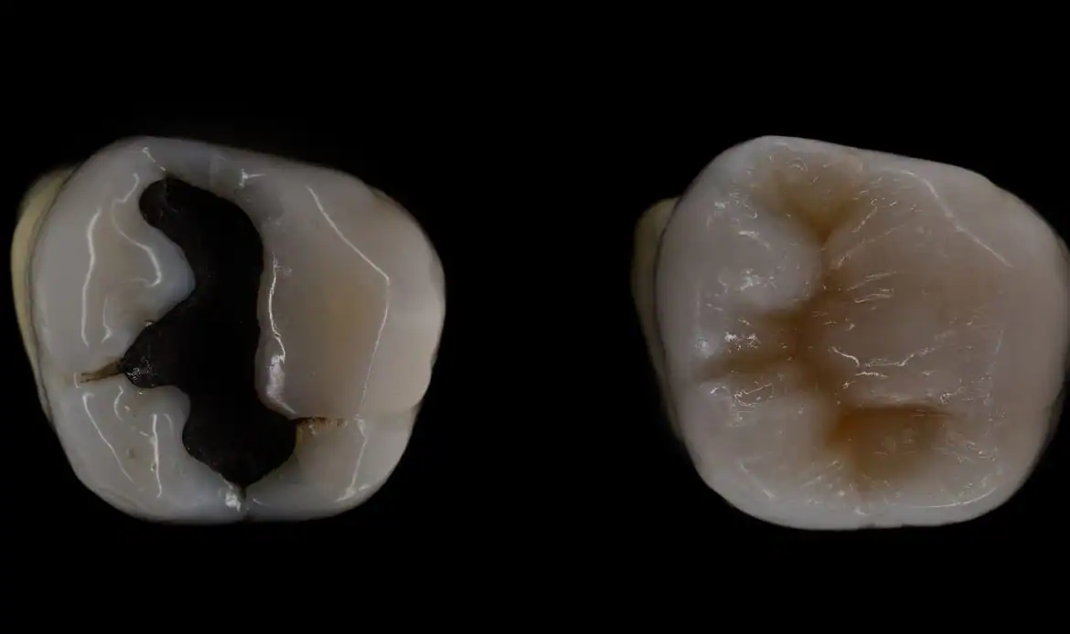 Amalgám tömés 6 Az amalgám tömés hátrányai