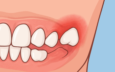 Fogínygyulladás bölcsességfog miatt – okok, tünetek és kezelési lehetőségek