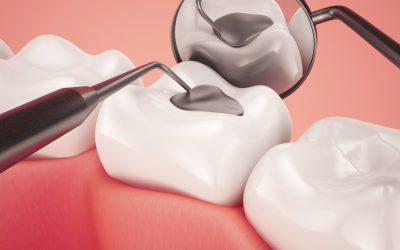 Amalgám tömés – minden, amit tudni érdemes a cseréről, eltávolításról és árakról