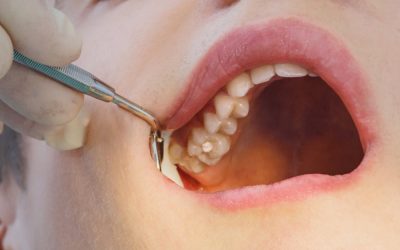 Felső bölcsességfog eltávolítás – tudnivalók, kockázatok és gyakori kérdések