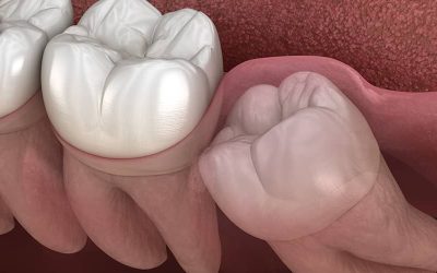 Mennyi idő alatt nő ki a bölcsességfog? – Teljes útmutató a növekedéstől a lehetséges problémákig