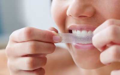 Otthoni fogfehérítés veszélyei – Amit mindenképp tudnod kell, mielőtt belevágsz